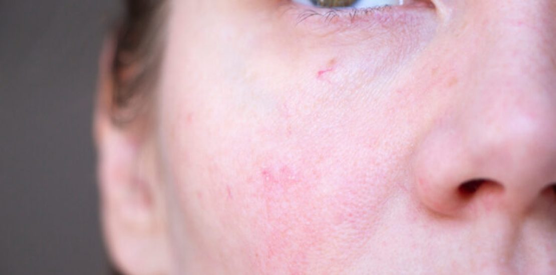 The,Girl,Has,Red,Capillaries,On,Her,Face